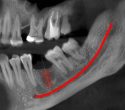 Giano implant tervezés